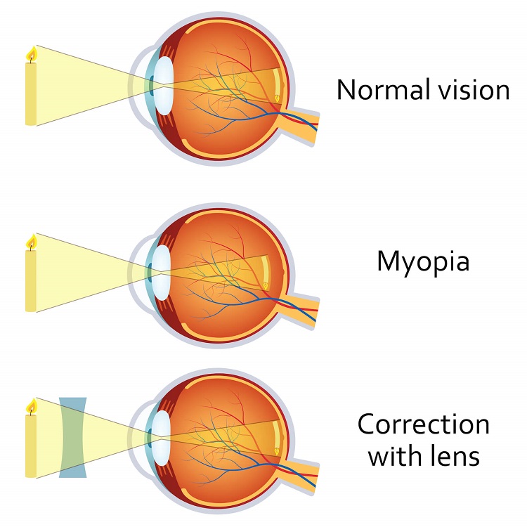 Myopia